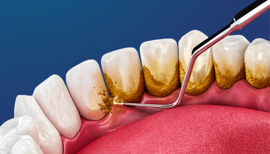 What Causes Tartar Buildup? Is Professional Cleaning Necessary?