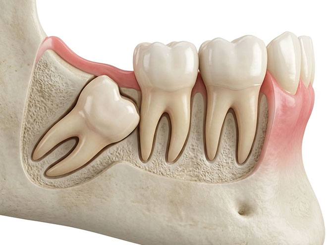 Wisdom Tooth Extraction