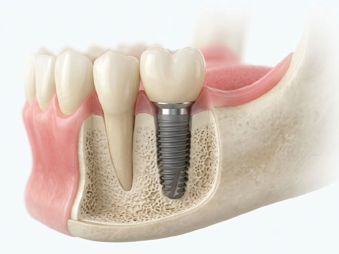Implant