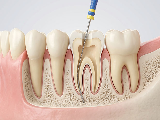 Root Canal Treatment