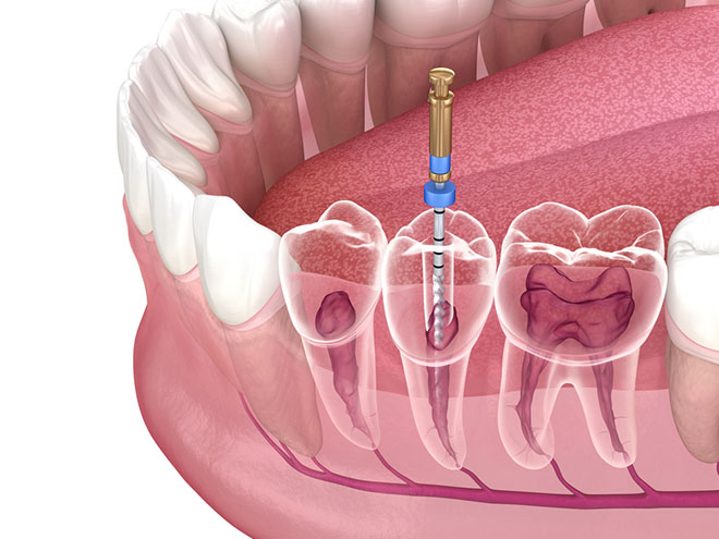 Root Canal Treatment